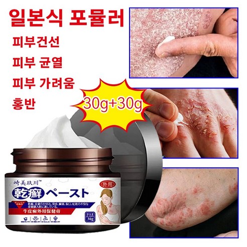 건선 건선 크림 습진 피부 가려움증 홍반 피부 균열 보습 크림 구매가이드 | 상세 리뷰 & 할인 정보 post thumbnail image